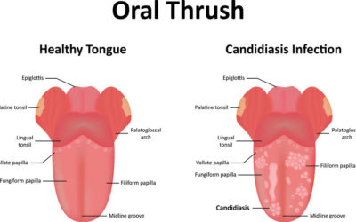 How long does Oral Thrush last without treatment?