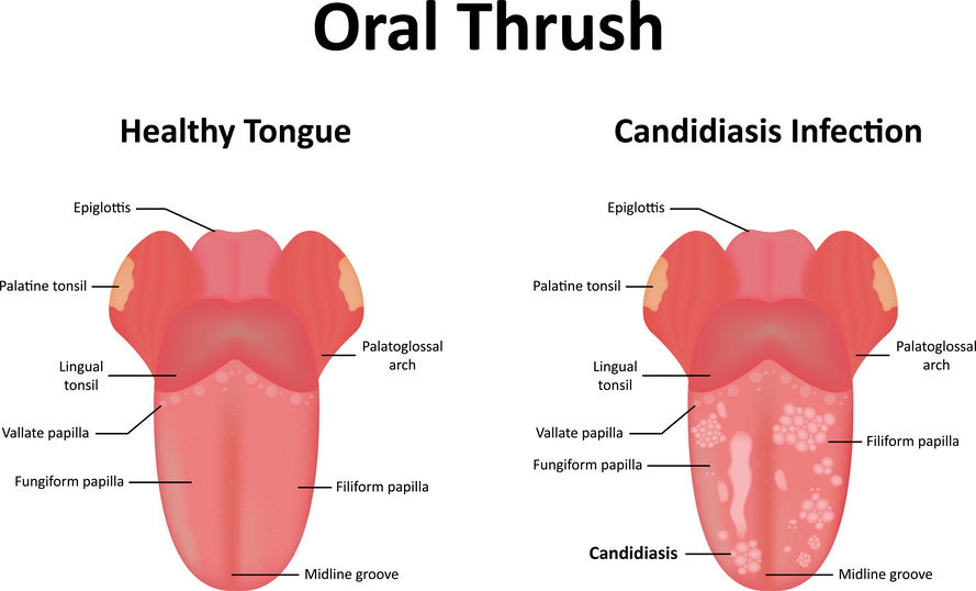 Medication for oral thrush deals in adults