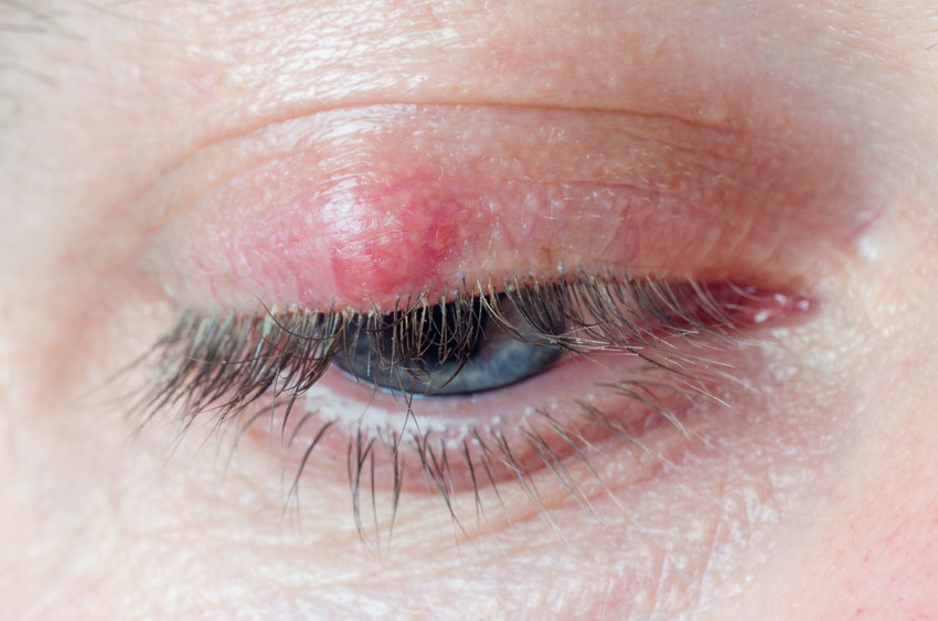 Styes: What they are and how to treat them