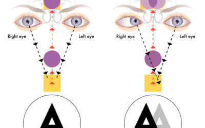 Double Vision – Cause and Treatment