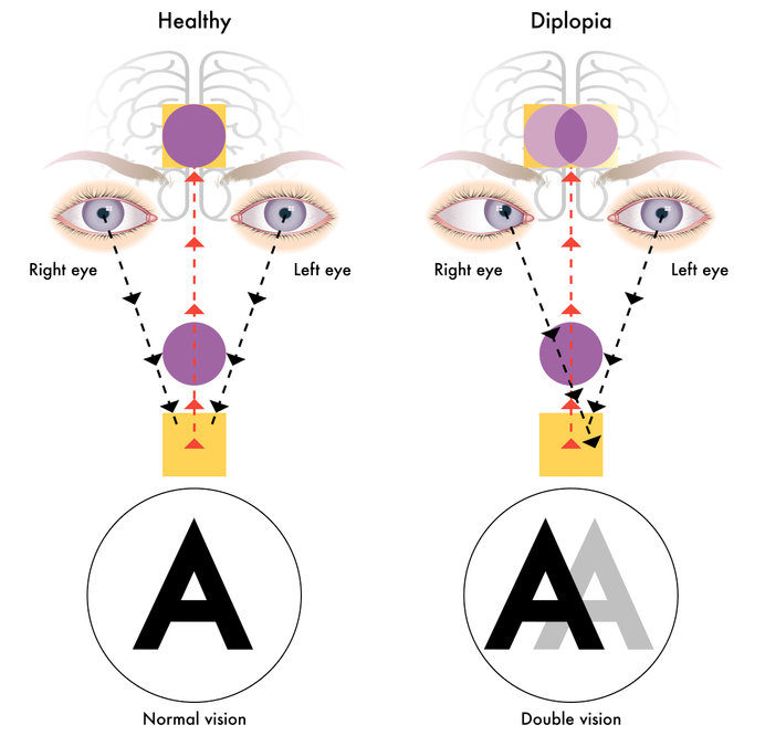 Double Vision – Cause and Treatment