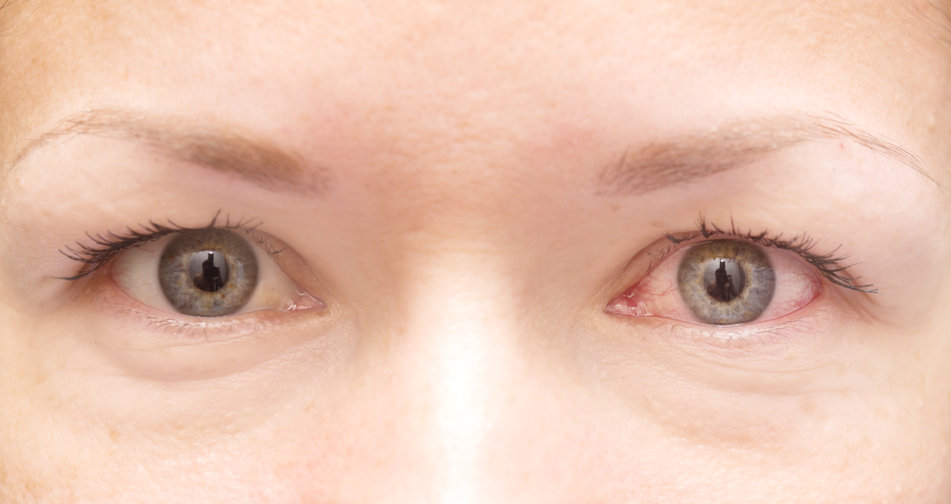 Type 2 Diabetes and its effect on Your Eyes