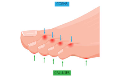 Over-the-Counter Treatments for Corns and Calluses