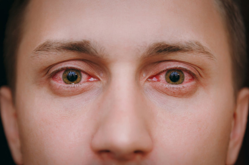 How Thyroid Disease Can Affect Your Eyes