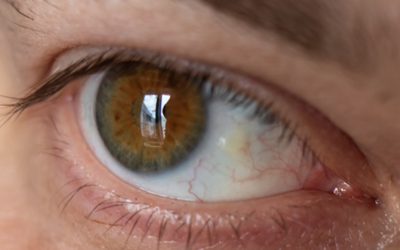 Pinguecula: What is that bump on my eye?￼