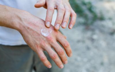 New Cream Approved for Plaque Psoriasis