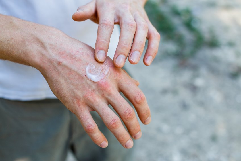 New Cream Approved for Plaque Psoriasis